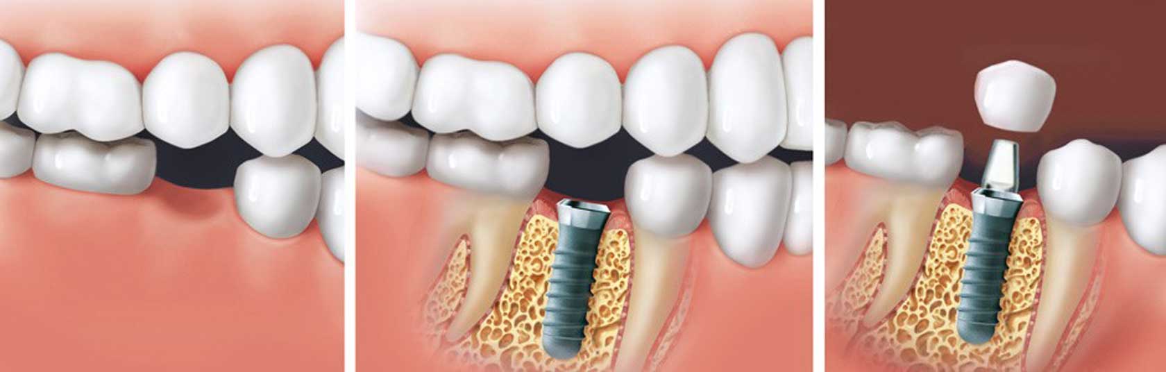 Zahnersatz implantate