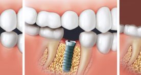 Implantate Zahnarzt Interlaken